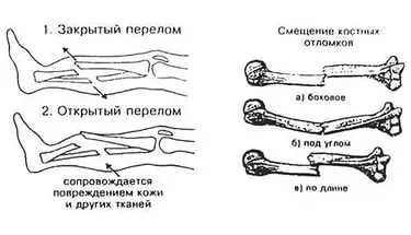 Първа помощ при счупени крайници