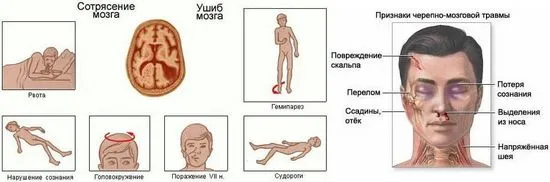 Светлинапризнаци на сътресение, симптоми, лечение