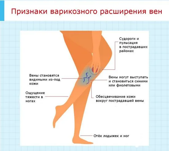 Симптоми на разширени вени, как да не започнете заболяването