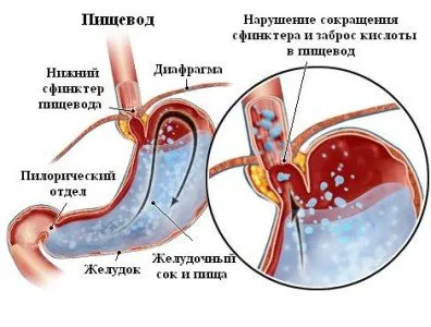 Стеснение (стеноза, стриктура) на хранопровода, симптоми, причини, лечение