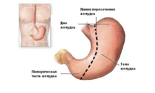 Операция за намаляване на стомаха