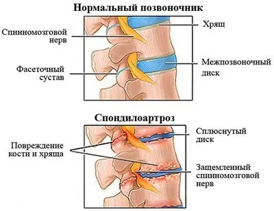 Спондилоартроза симптоми, лечение и профилактика