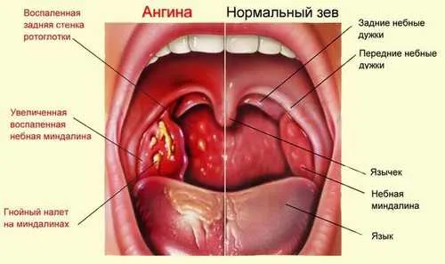 Гаргара при болки в гърлото