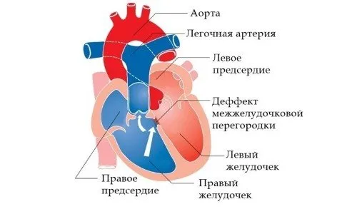 Сърдечни операции, показания и видове, рехабилитационен период (видео)