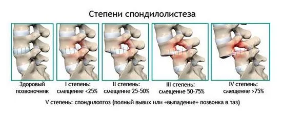 спондилолистеза