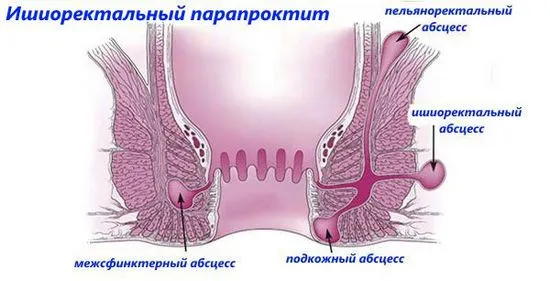 Ние лекуваме парапроктит бързо и ефективно