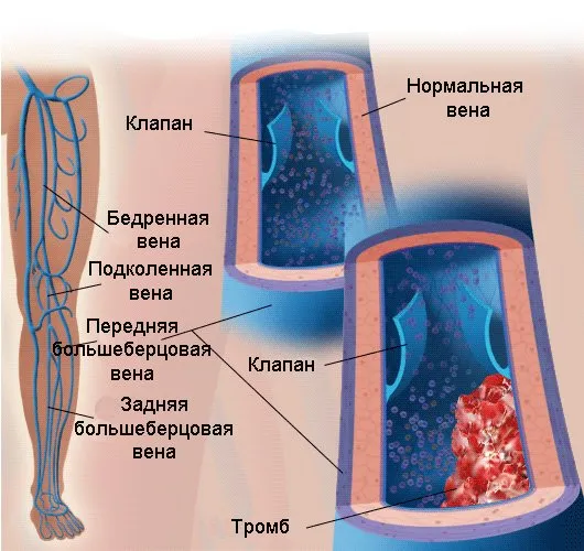 Лечение на тромбофлебит на долните крайници