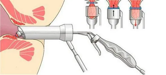 Минимално инвазивна хирургия на хемороиди, лигиране с латекс