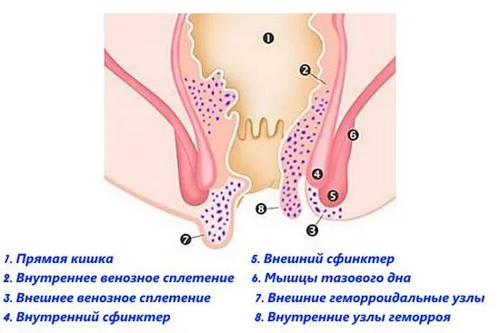 хемороидите