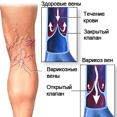 Компресионен трикотаж за разширени вени