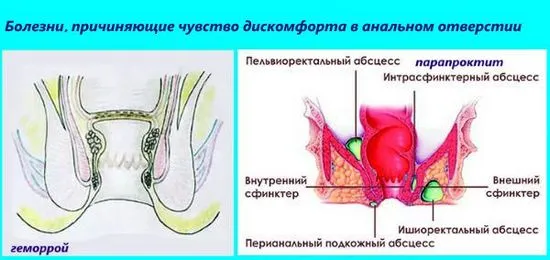 Причините за появата на чувство на натиск в областта на ануса