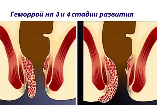 Методи за радикална операция за хемороидектомия