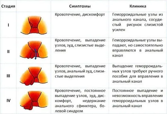 Как да се справим с хемороидите у дома