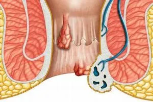 Хронични комбинирани хемороиди от 2-ра, 3-та, 4-та степен, какво е това, симптоми, лечение