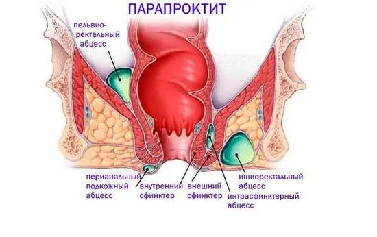 Опасно усложнение на хемороидите е парапроктитът