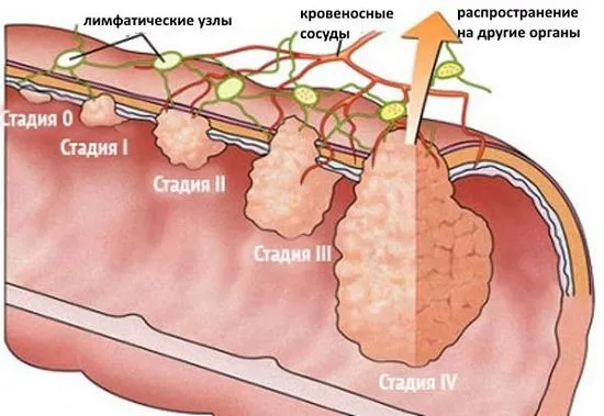 Как е оперативната намеса при състояниетоотстраняване на рак на ректума