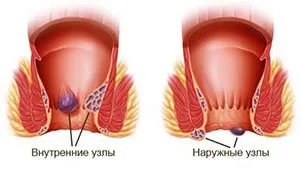 Лазерната коагулация като модерен начин да се отървете от хемороиди