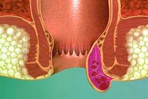 Какво характеризира появата на външни хемороиди
