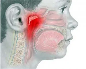 Аденоидит при деца, симптоми и лечение