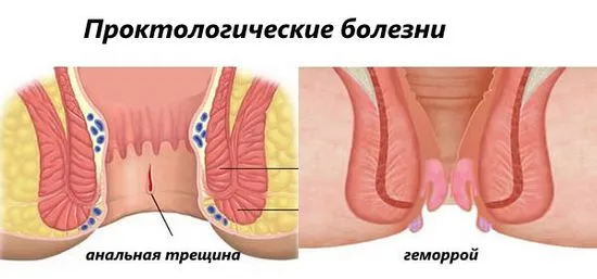 Какво означава появата на топка близо до ануса