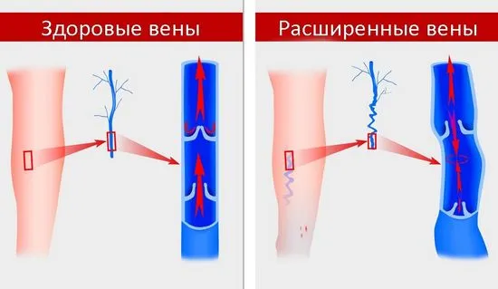 Лечение на разширени вени с народни средства