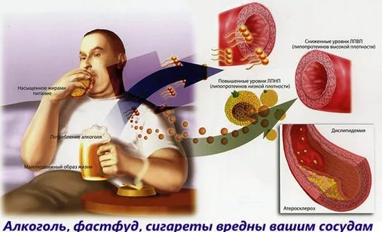 Възможно ли е да се пие алкохол с разширени хемороидални възли