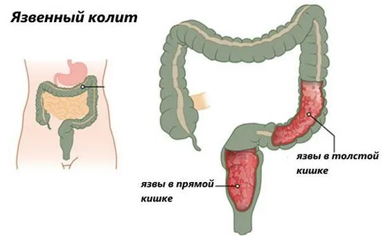 Как да разпознаем и лекуваме ректална язва