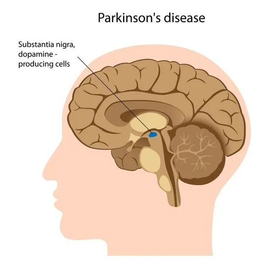 Диагностика и лечение на болестта на Паркинсон