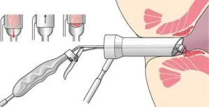 Лигиране на хемороиди (хемороидален възел) с латексови пръстени, прегледи, усложнения, цена
