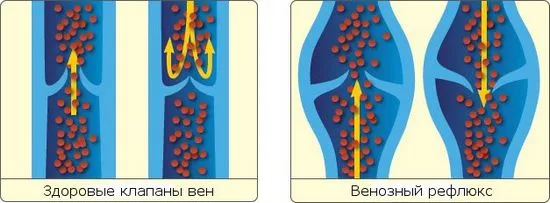 Каква е опасността от венозен рефлукс