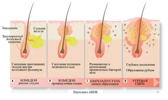 Darsonval от акне прегледи, как да използвате