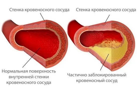 Етапи на атеросклероза