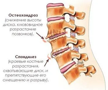 Симптоми и лечение на спондилоза