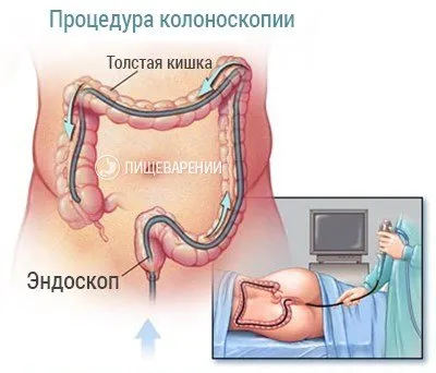 Чревна колоноскопия, какво е и как се прави