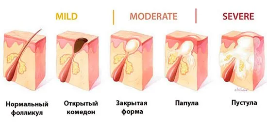 Какво представляват комедоните и как да се отървете от тях