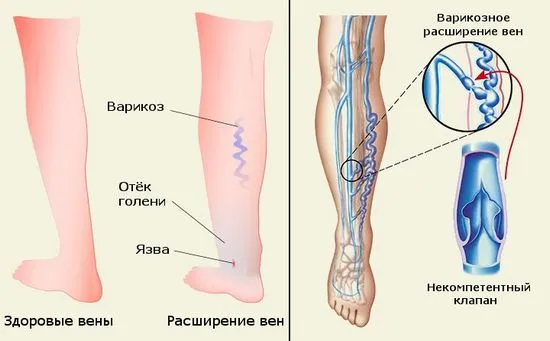 Предотвратяване на разширени вени на краката две схеми, тяхното действие