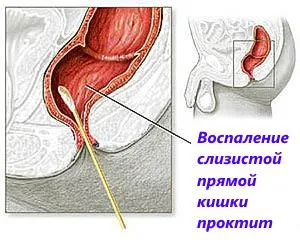 симптоми