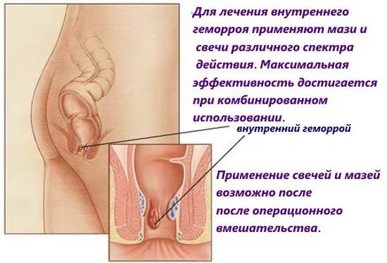 Лечение на хемороиди с най-добрите супозитории