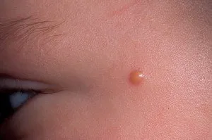 Nevus Spitz - причини, симптоми, диагноза, лечение, снимка