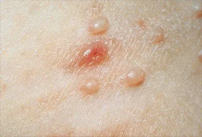 Molluscum contagiosum върху кожата на лицето, лечение, как да се отървете от кожното заболяване