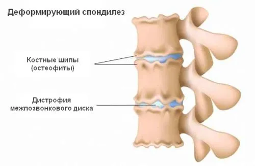 Деформираща спондилоза симптоми и лечение