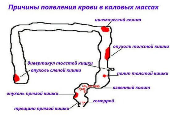 Какво може да бъде придружено от кървене от ректума