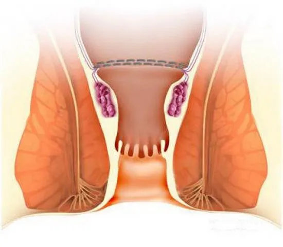 Признаци на вътрешни хемороиди