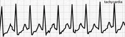 Домашно лечение на тахикардия