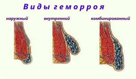Какво да правим с хронични хемороиди от втора степен