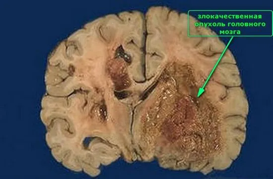 Причини за глиобластом, симптоми, видове тумори, диагностика и лечение