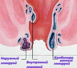 С какво се характеризира втората степен на хемороиди