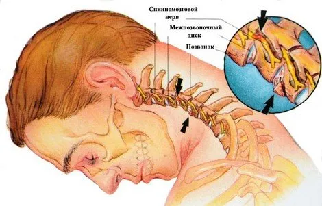 Симптоми и признаци на цервикална остеохондроза