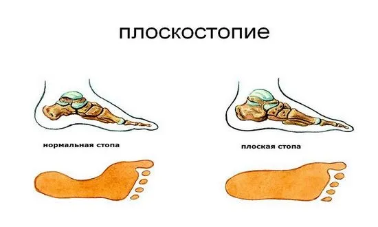 Операция за плоски стъпала