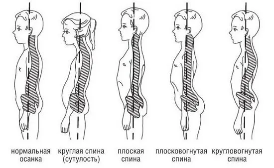 Нарушение на позата при деца в училищна възраст, диагностика на сколиоза